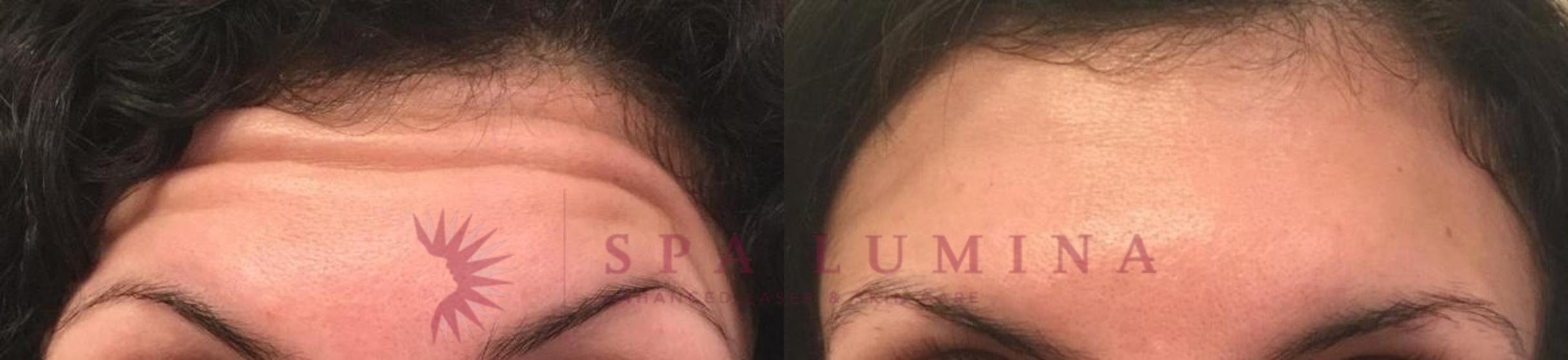 Before & After BOTOX® COSMETIC Case 1 Front View in Barrie, Ontario