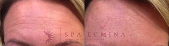 Before & After BOTOX® COSMETIC Case 10 Front View in Barrie, Ontario