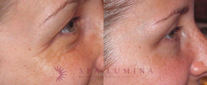 Before & After BOTOX® COSMETIC Case 11 Right Side View in Barrie, Ontario