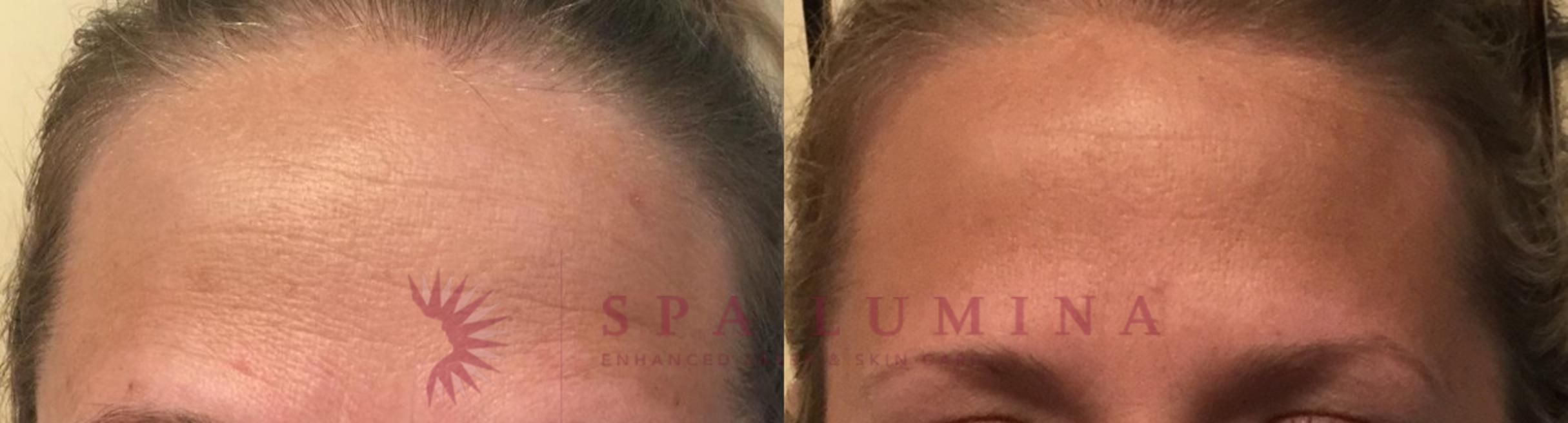 Before & After BOTOX® COSMETIC Case 2 Front View in Barrie, Ontario