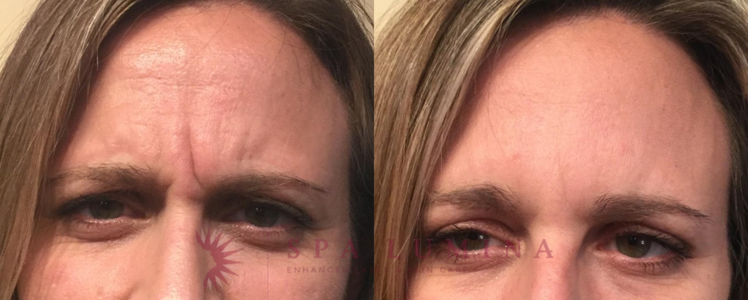 Before & After BOTOX® COSMETIC Case 3 Front View in Barrie, Ontario