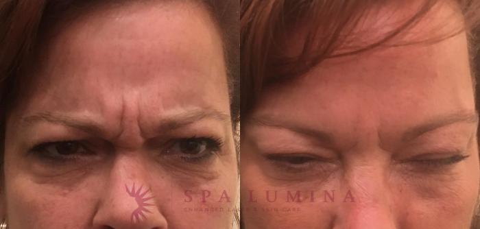 Before & After BOTOX® COSMETIC Case 4 Front View in Barrie, Ontario