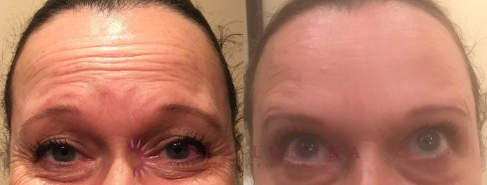 Before & After BOTOX® COSMETIC Case 5 Front View in Barrie, Ontario