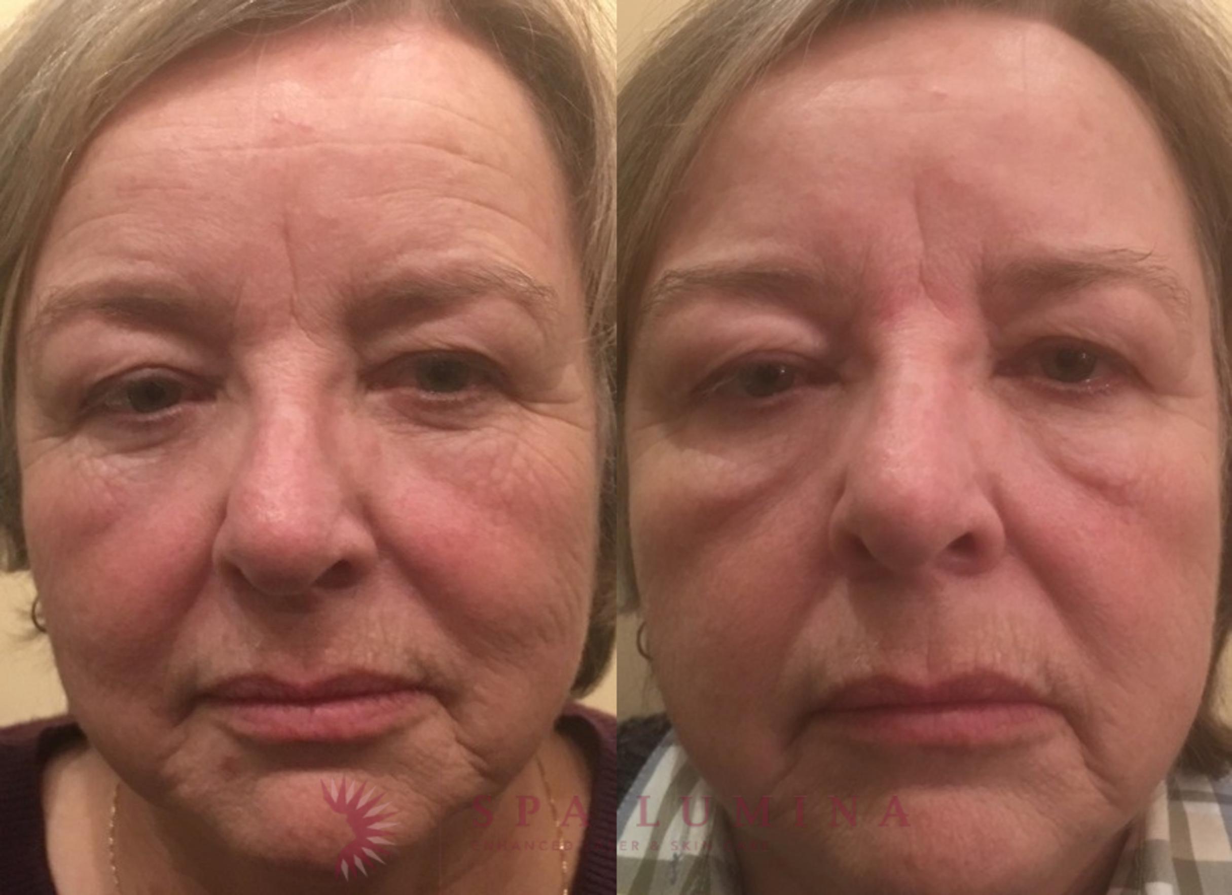 Before & After BOTOX® COSMETIC Case 6 Front View in Barrie, Ontario