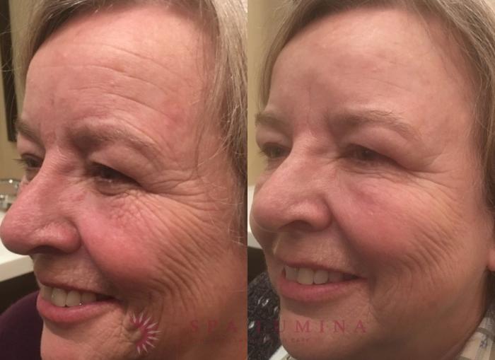 Before & After BOTOX® COSMETIC Case 6 Left Oblique View in Barrie, Ontario