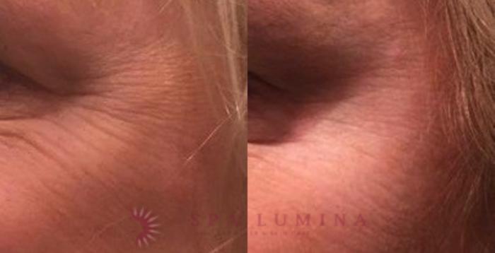 Before & After BOTOX® COSMETIC Case 8 Left Oblique View in Barrie, Ontario