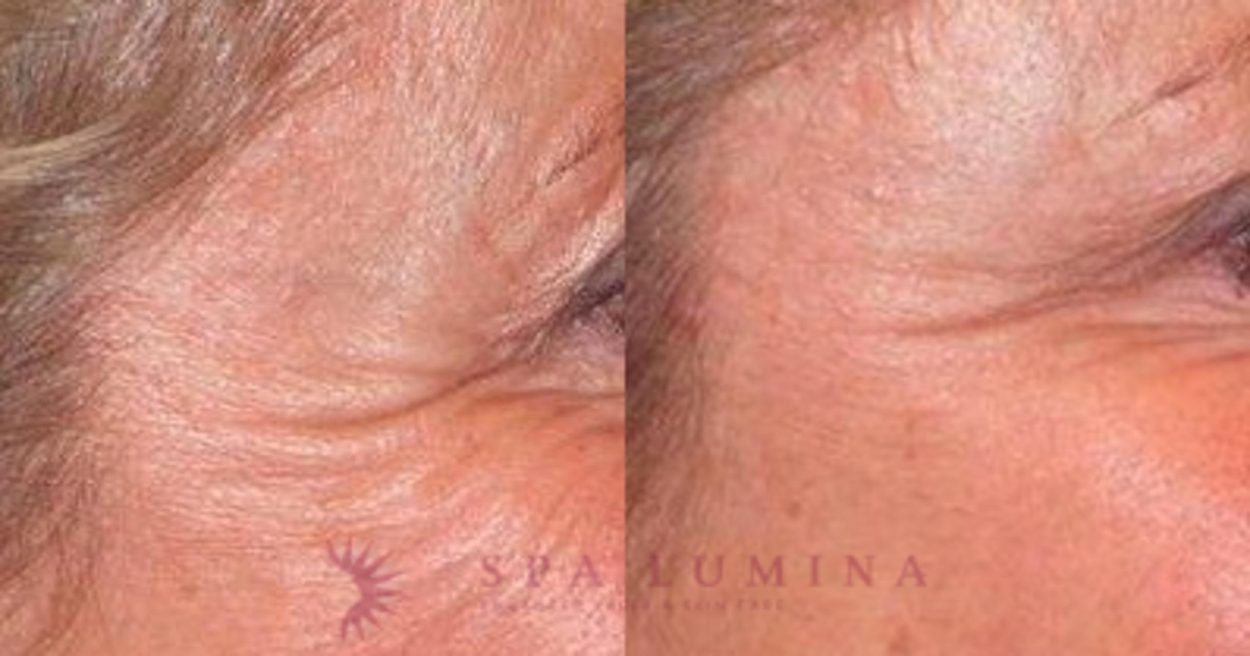 Before & After BOTOX® COSMETIC Case 9 Right Oblique View in Barrie, Ontario