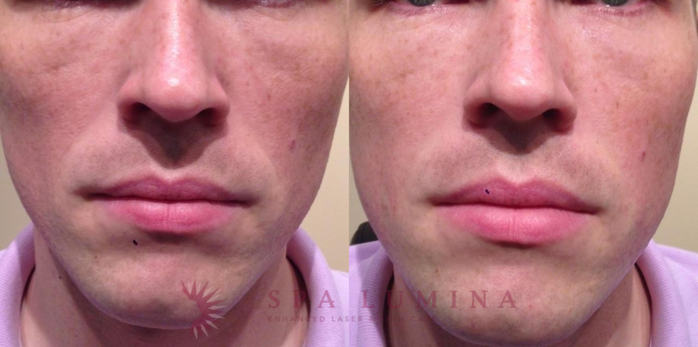 Before & After Dermal Fillers Case 63 Front View in Barrie, Ontario