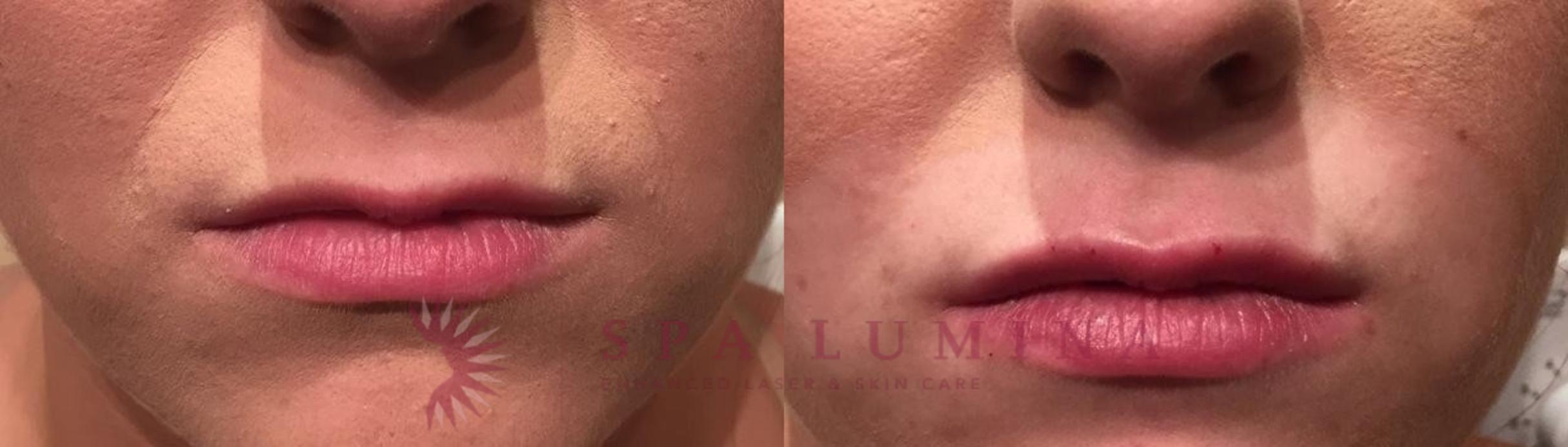 Before & After Dermal Fillers Case 64 Front View in Barrie, Ontario