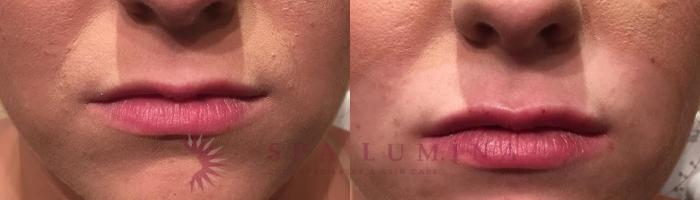 Before & After Dermal Fillers Case 64 Front View in Barrie, Ontario