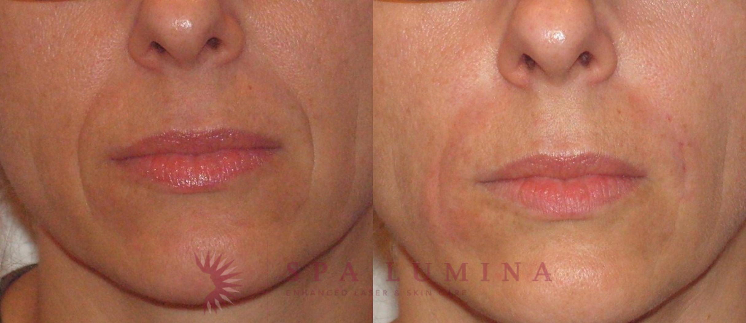 Before & After Dermal Fillers Case 65 Front View in Barrie, Ontario