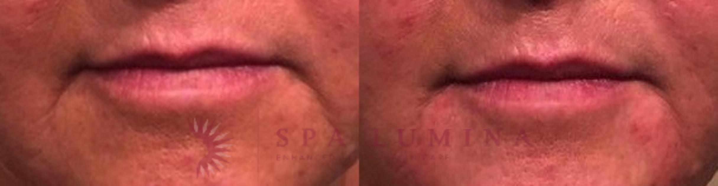 Before & After Dermal Fillers Case 66 Front View in Barrie, Ontario