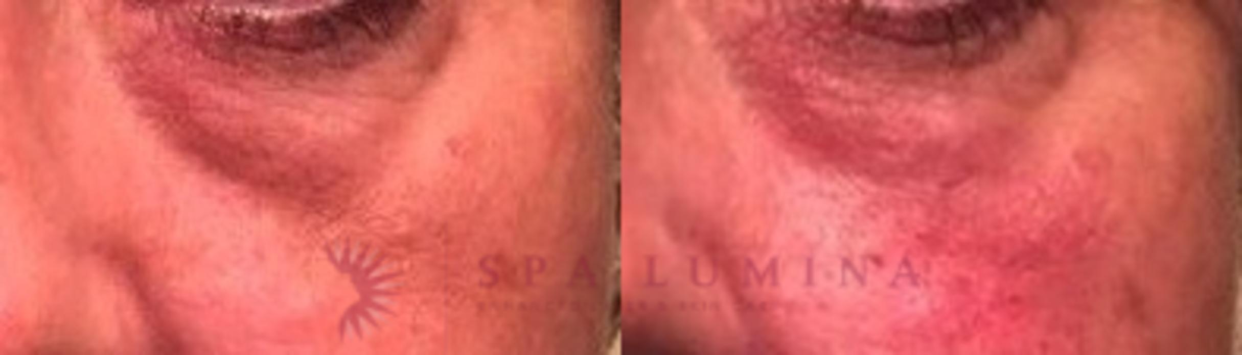 Before & After Dermal Fillers Case 67 Front View in Barrie, Ontario