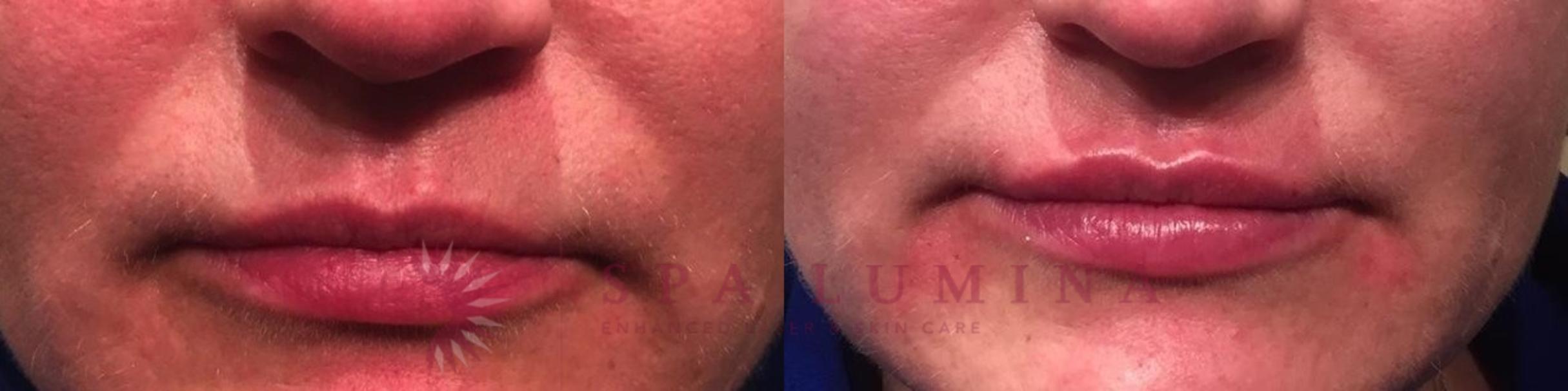 Before & After Dermal Fillers Case 68 Front View in Barrie, Ontario