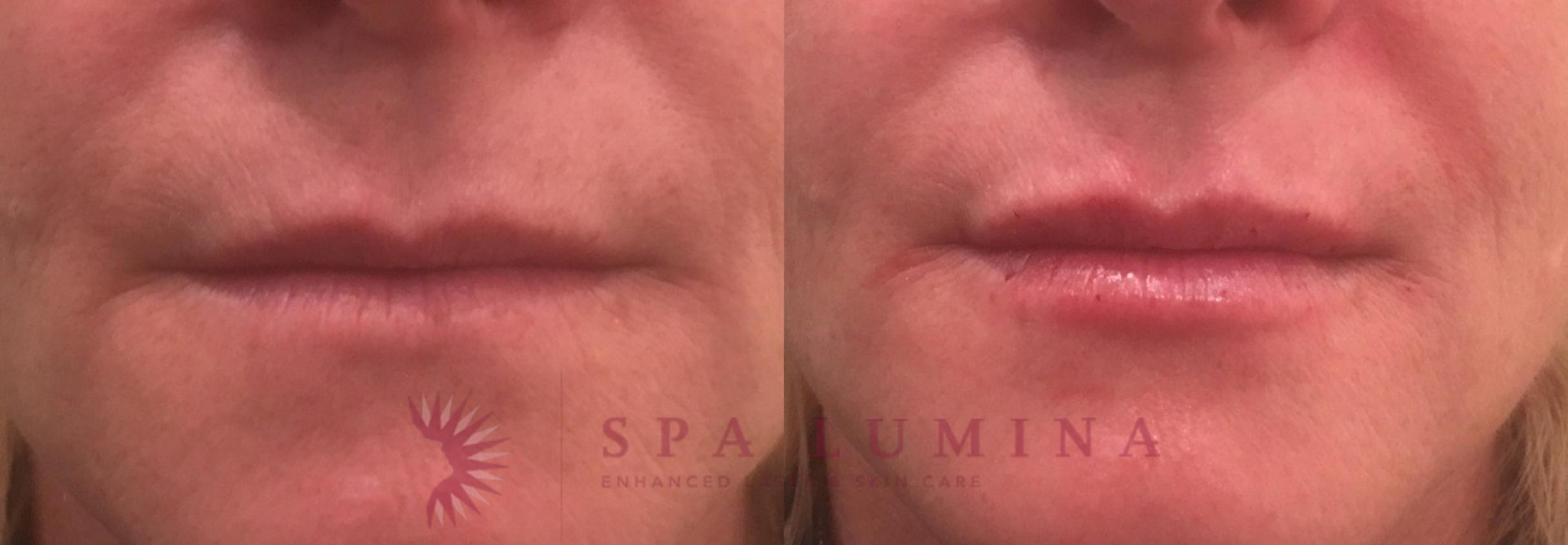 Before & After Dermal Fillers Case 69 Front View in Barrie, Ontario