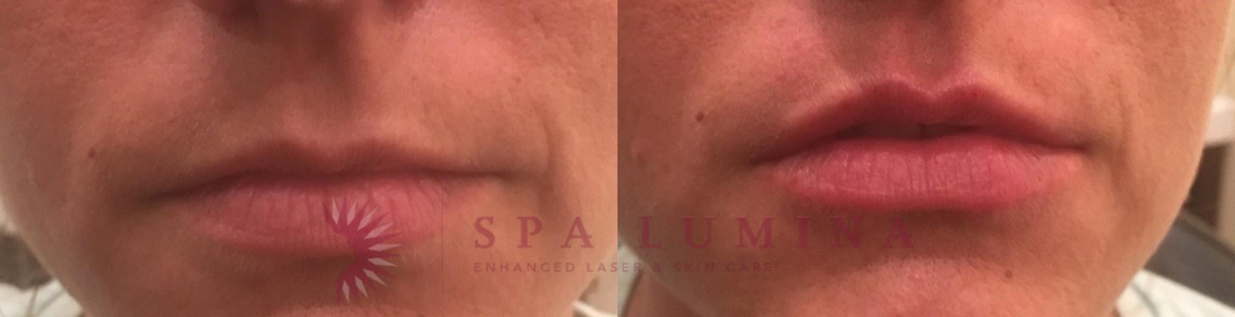 Before & After Dermal Fillers Case 70 Front View in Barrie, Ontario