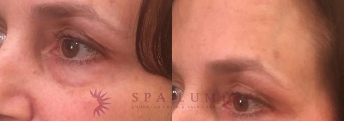 Before & After Dermal Fillers Case 71 Left Oblique View in Barrie, Ontario