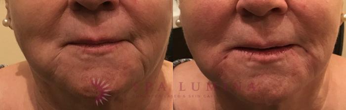 Before & After Dermal Fillers Case 72 Front View in Barrie, Ontario