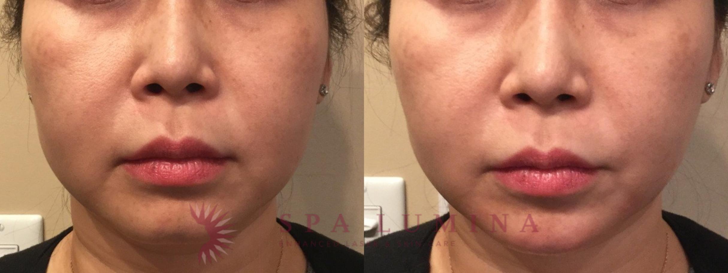 Before & After Dermal Fillers Case 73 Front View in Barrie, Ontario