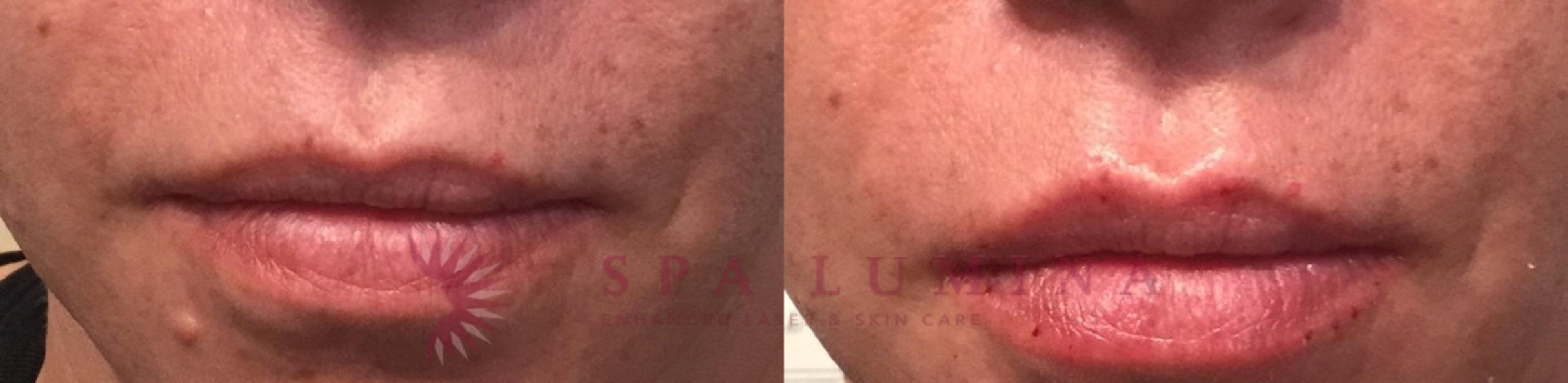 Before & After Dermal Fillers Case 74 Front View in Barrie, Ontario