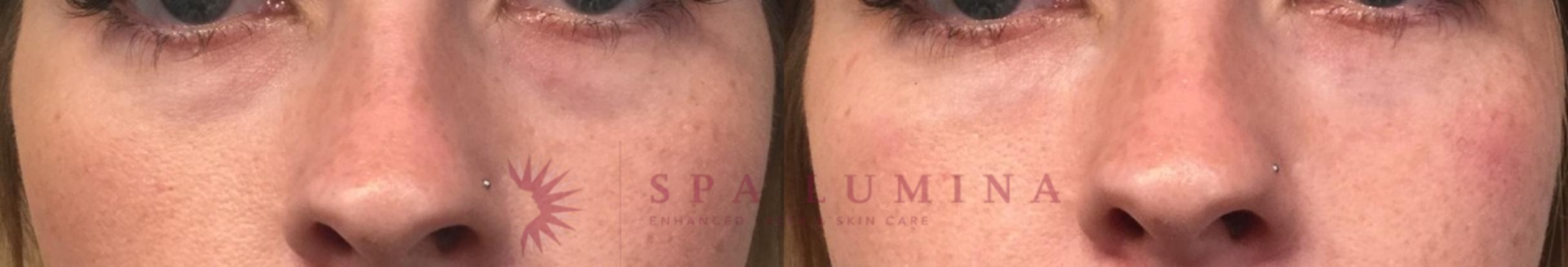 Before & After Dermal Fillers Case 75 Front View in Barrie, Ontario