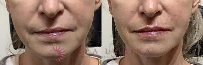 Before & After Dermal Fillers Case 80 Front View in Barrie, Ontario