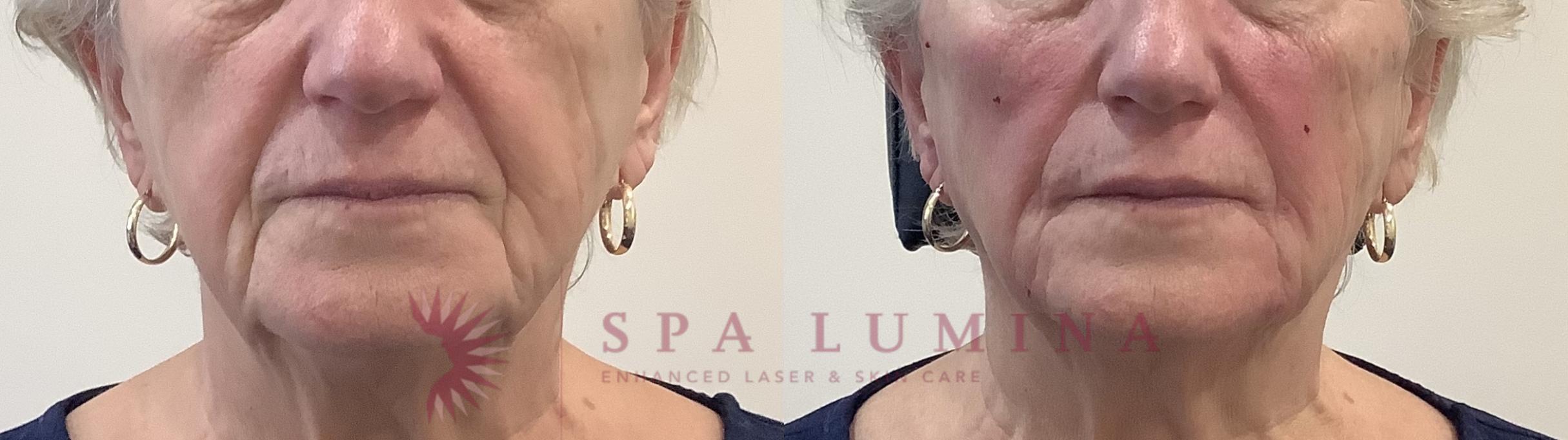 Before & After Dermal Fillers Case 84 Front View in Barrie, Ontario