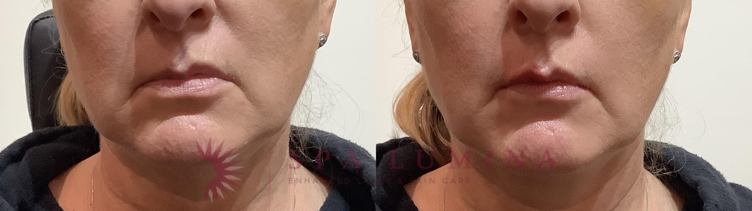 Before & After Dermal Fillers Case 86 Front View in Barrie, Ontario