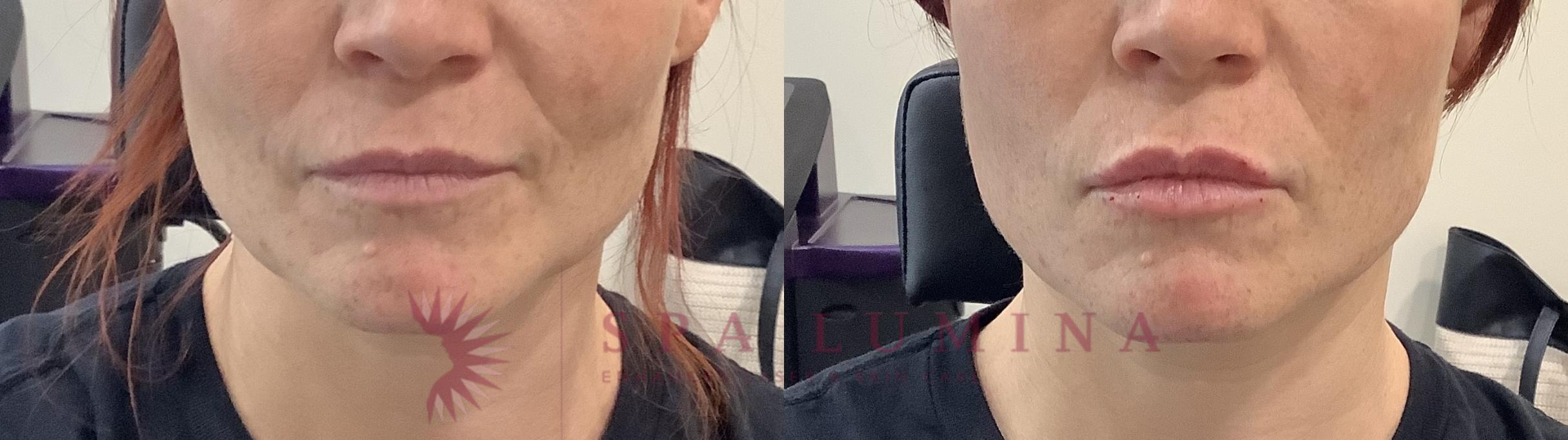 Before & After Dermal Fillers Case 93 Front View in Barrie, Ontario