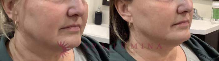 Before & After Dermal Fillers Case 97 Right Side View in Barrie, Ontario