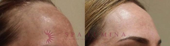 Before & After IPL Photofacial Case 46 Right Oblique View in Barrie, Ontario