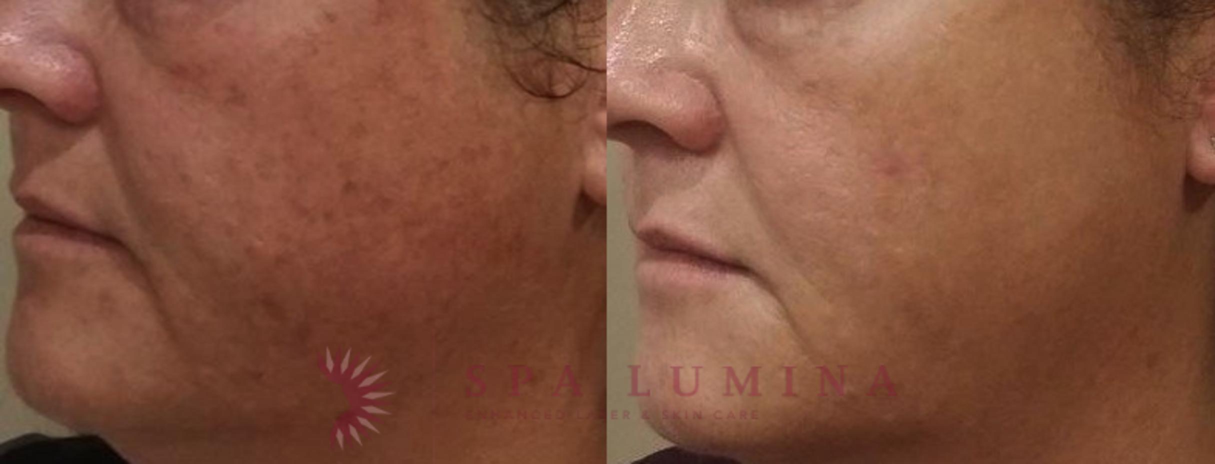 Before & After IPL Photofacial Case 47 Left Oblique View in Barrie, Ontario