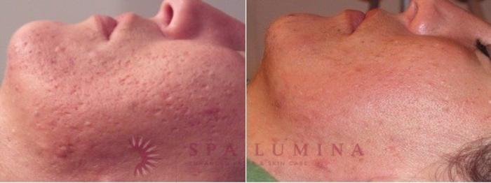 Before & After Laser Genesis Case 50 Left Side View in Barrie, Ontario