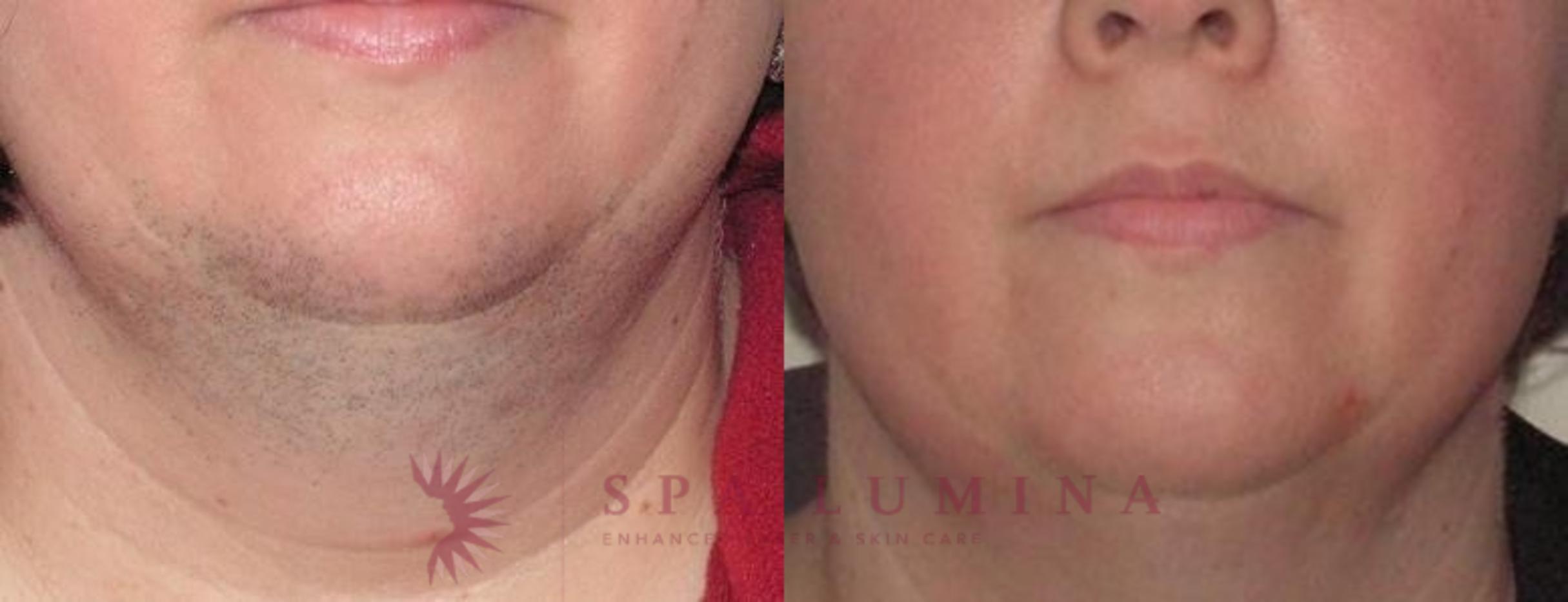 Before & After Laser Hair Removal Case 58 Front View in Barrie, Ontario