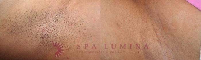 Before & After Laser Hair Removal Case 59 Front View in Barrie, Ontario