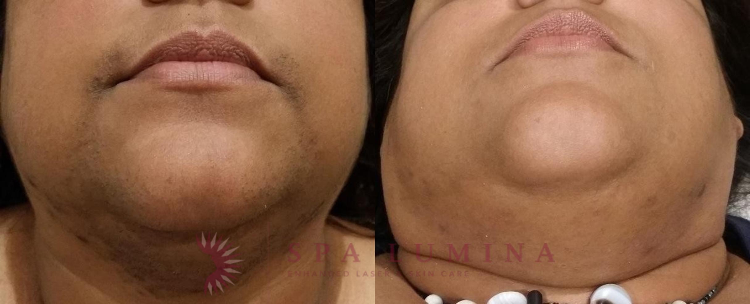 Before & After Laser Hair Removal Case 60 Front View in Barrie, Ontario