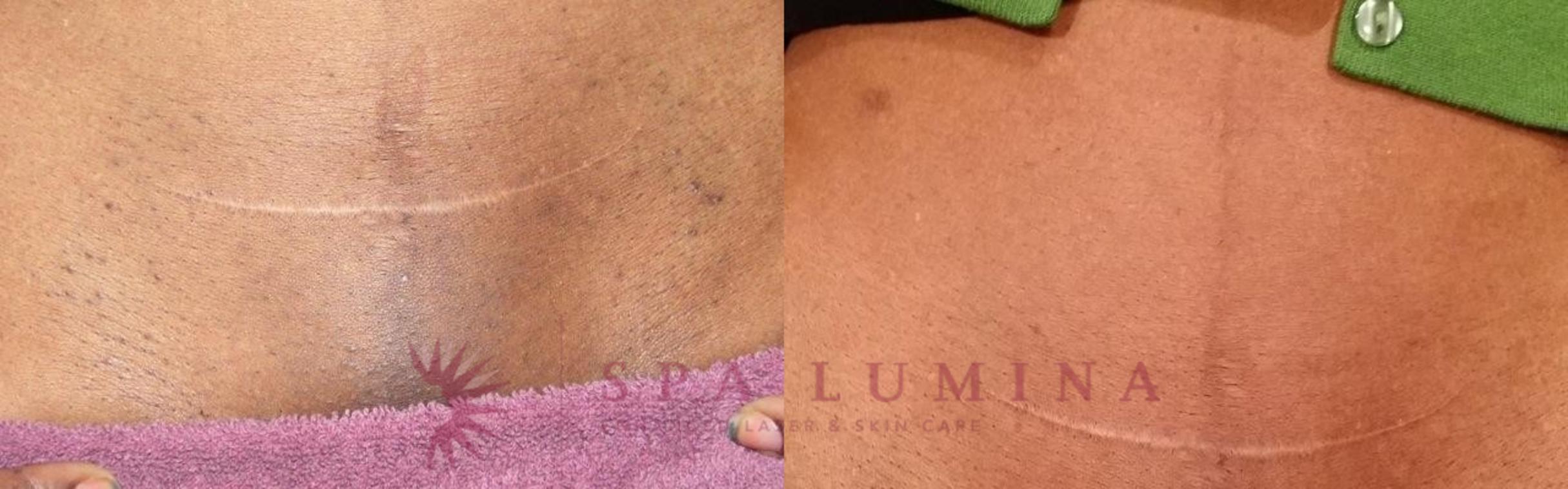 Before & After Laser Hair Removal Case 61 Front View in Barrie, Ontario