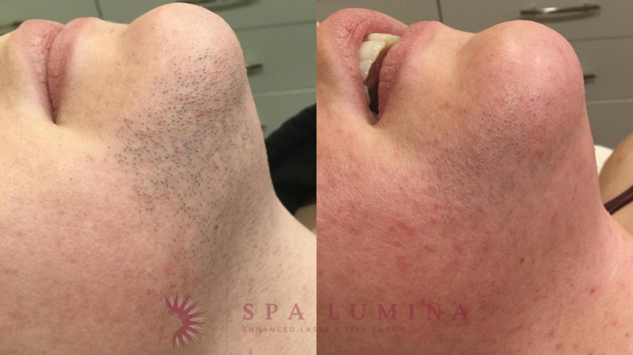 Before & After Laser Hair Removal Case 62 Right Side View in Barrie, Ontario