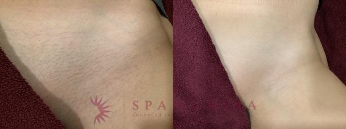 Before & After Laser Hair Removal Case 87 Front View in Barrie, Ontario