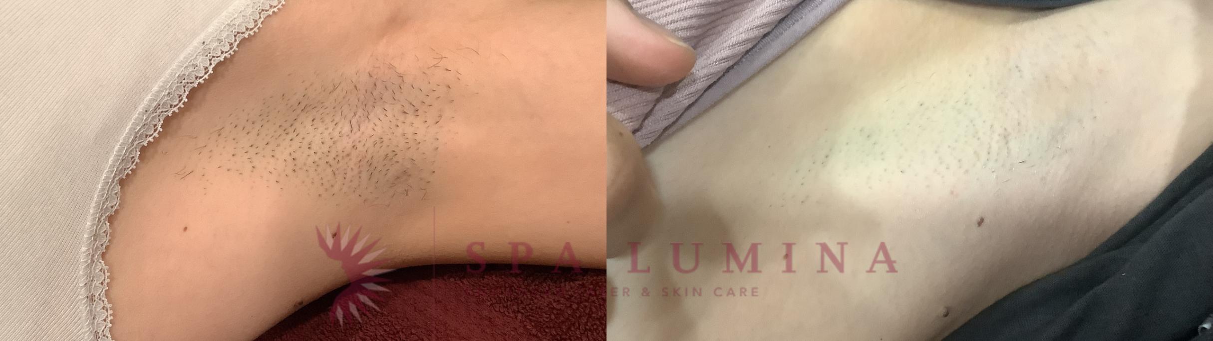 Before & After Laser Hair Removal Case 88 Left Side View in Barrie, Ontario