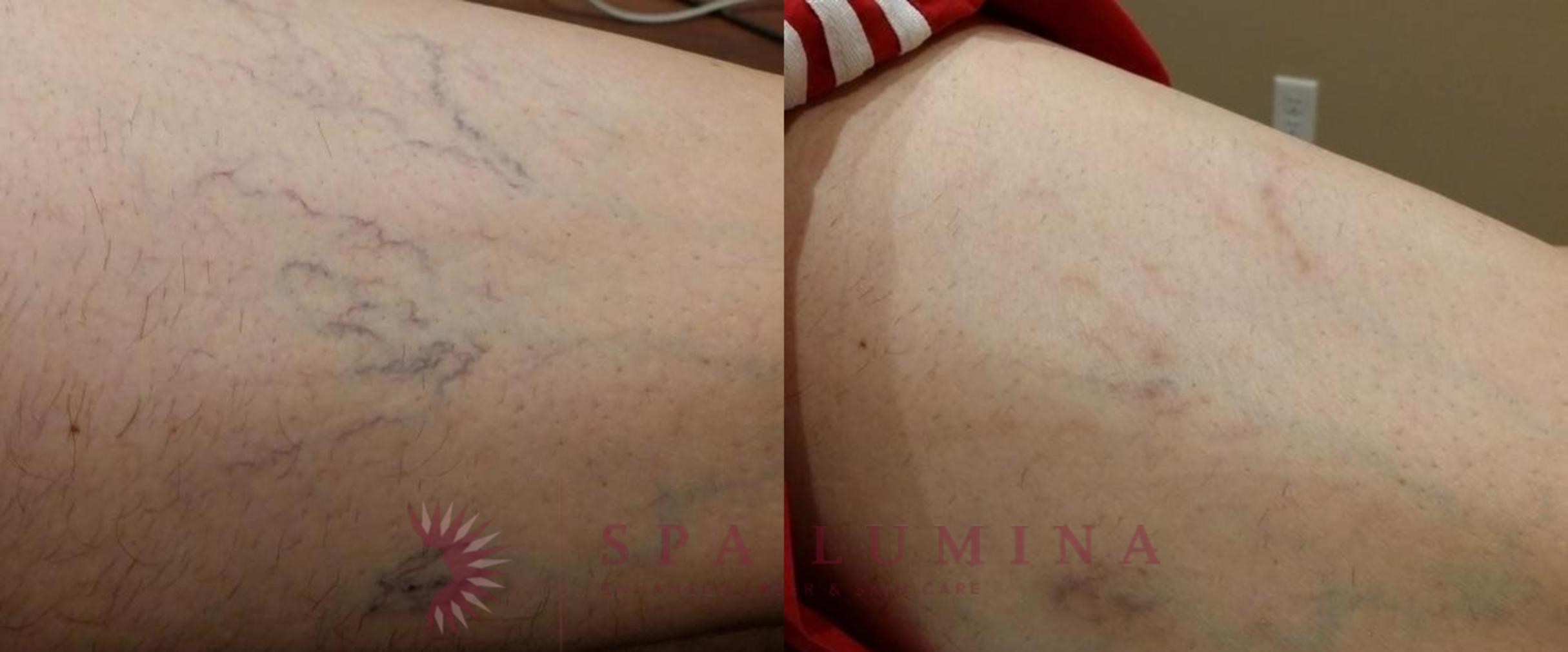 Before & After Laser Vein Removal Case 52 Front View in Barrie, Ontario