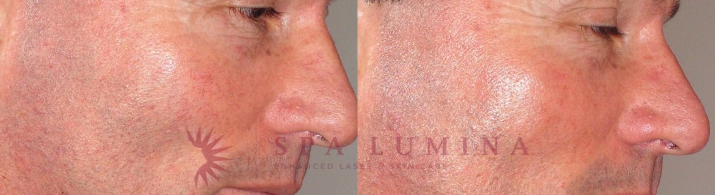 Before & After Laser Vein Removal Case 53 Right Side View in Barrie, Ontario