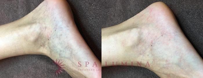 Before & After Laser Vein Removal Case 56 Front View in Barrie, Ontario