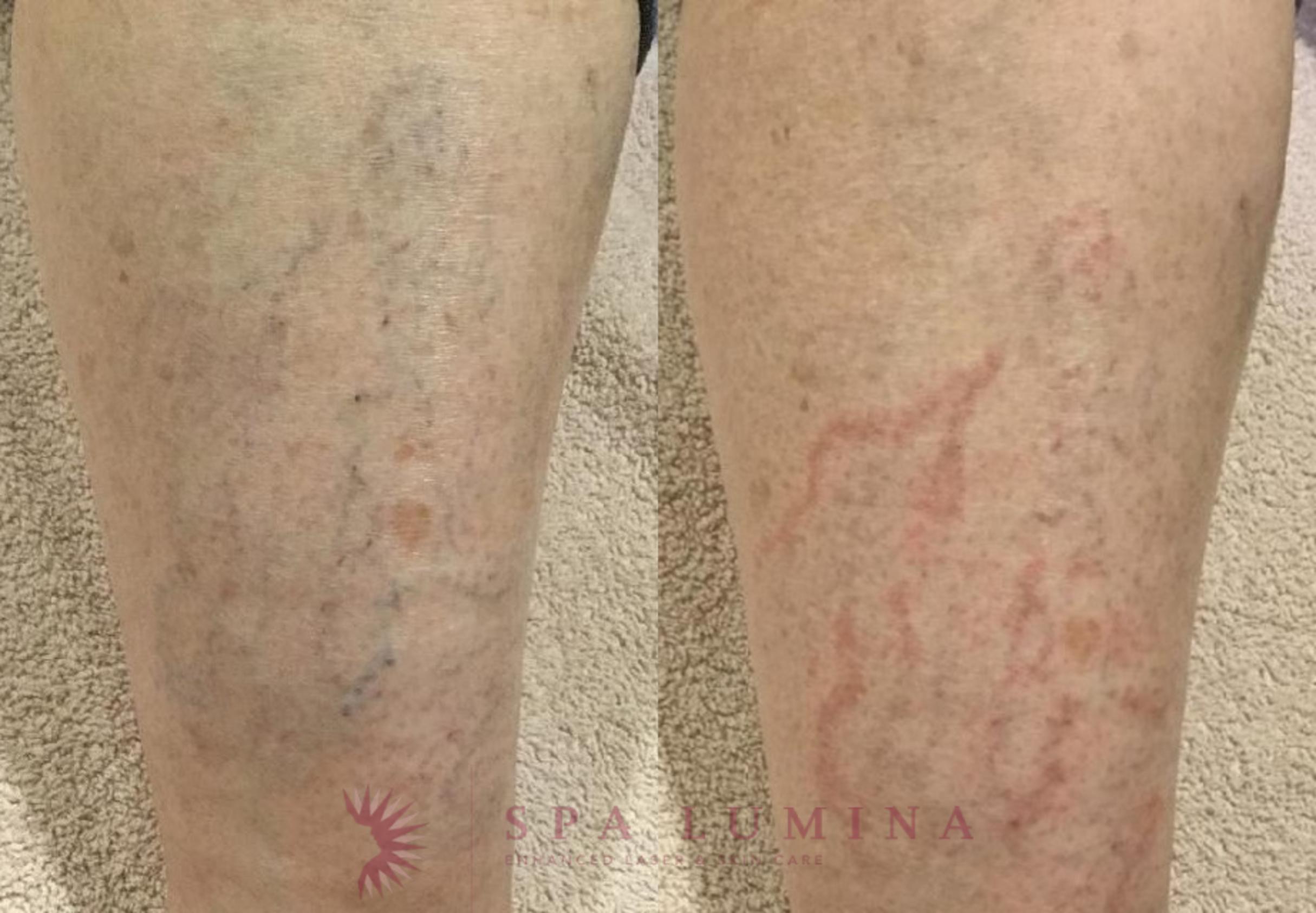 Before & After Laser Vein Removal Case 57 Front View in Barrie, Ontario