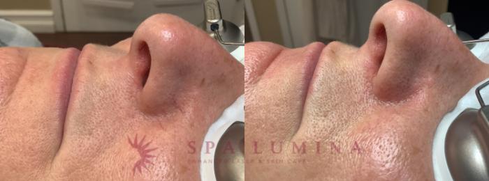 Before & After Laser Vein Removal Case 95 Left Side View in Barrie, Ontario