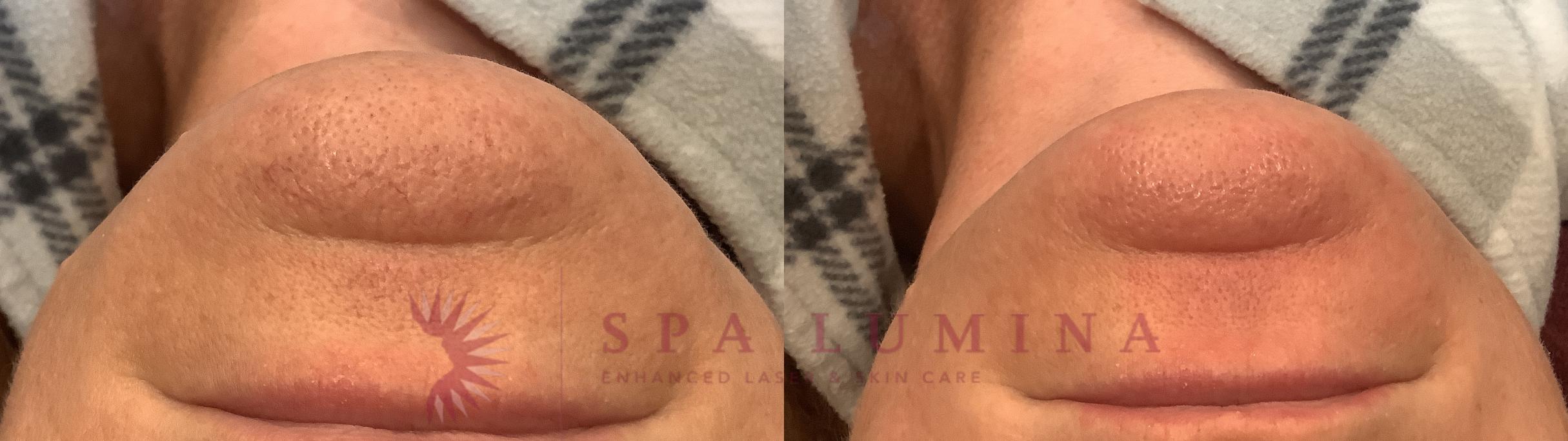 Before & After Laser Vein Removal Case 96 Chin View in Barrie, Ontario