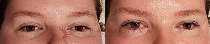 Before & After Lash Lift & Brow Lamination Case 78 Front View in Barrie, Ontario