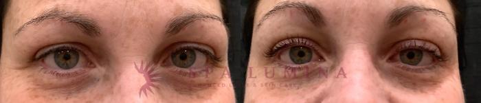 Before & After Lash Lift & Brow Lamination Case 79 Front View in Barrie, Ontario