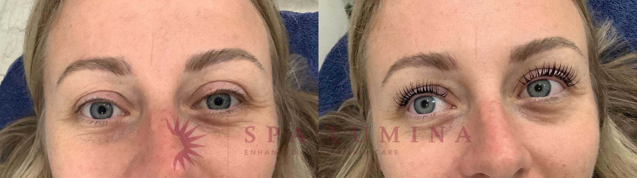 Before & After Lash Lift & Brow Lamination Case 92 Front View in Barrie, Ontario