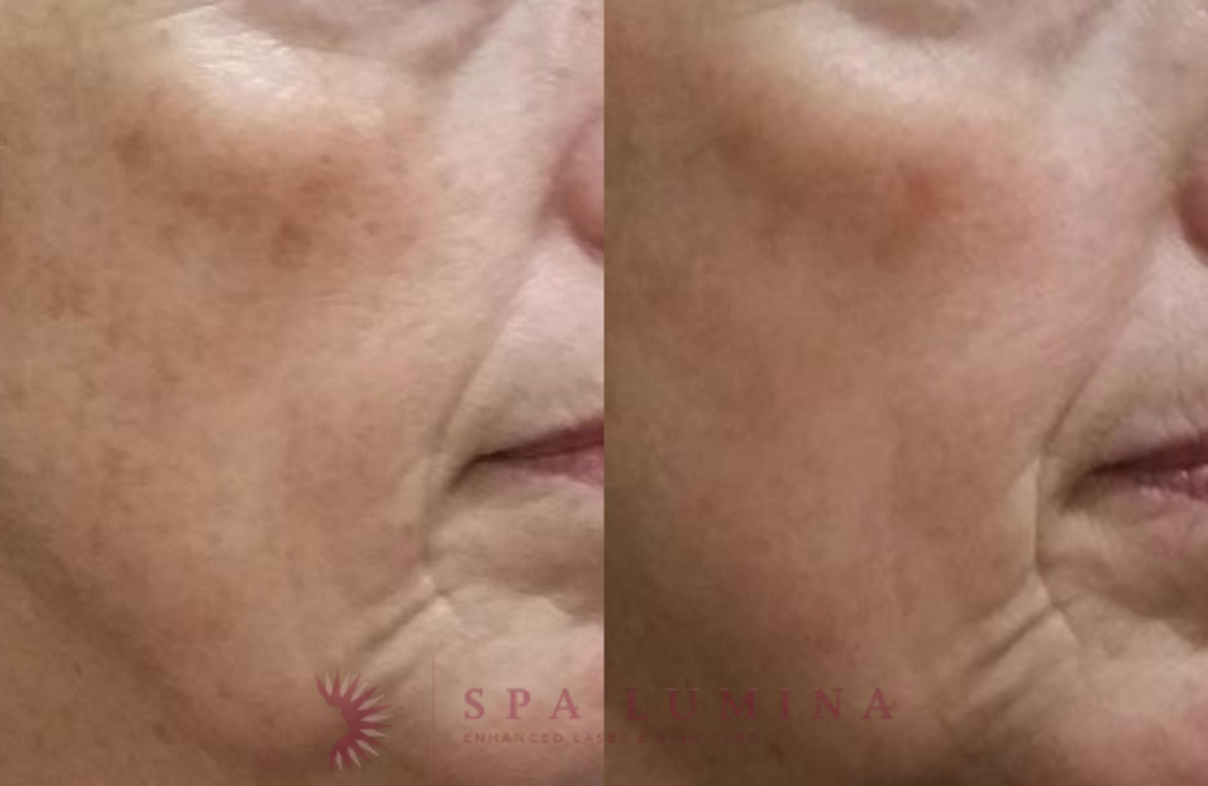 Before & After Photodynamic Therapy Case 48 Right Oblique View in Barrie, Ontario